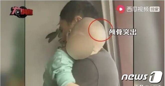 가짜 분유를 먹고 두개골이 커지는 부작용이 나타난 중국 아기(출처=신경보 갈무리)© 뉴스1