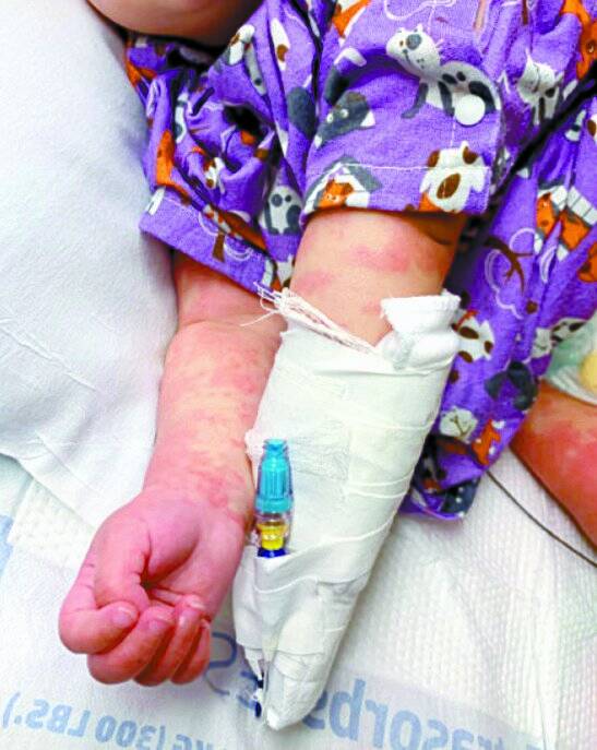 4월달 미국 소아과 학회가 발표한 가와사키 병을 앓고 있는 아이의 모습. 생후 6개월의 이 아이는 코로나19 양성 판정을 받았다. [미국 소아과 협회 제공]