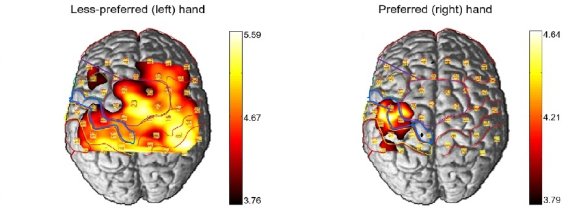 왼쪽 뇌 사진을 보면 동일한 수동촉각 자극에 대해 왼손은 좌우 반구 대칭성이 높아 뇌 활성화 단면이 넓은 반면, 오른쪽 사진에는 오른손이 감각운동피질의 대뇌 좌우 반구 대칭성이 낮아 뇌 활성화 단면이 좁다. DGIST 제공