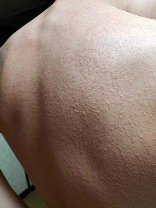 ▲콜린성 두드러기. 한림대의료원 제공.