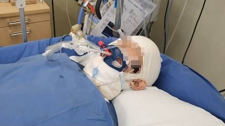 지하철역 감전사고로 전신화상 입은 중학생. 연합뉴스