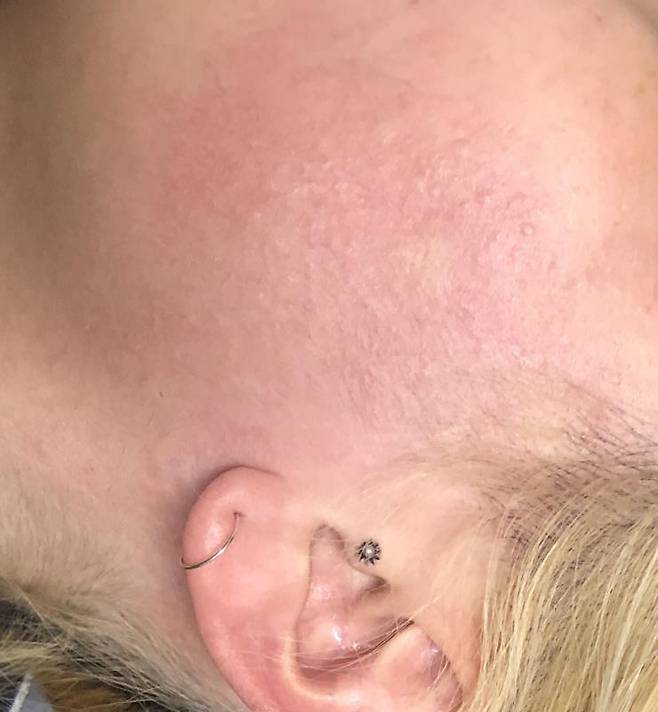 4일차 두드러기