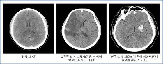 정상인과 뇌졸중(뇌경색·뇌출혈) 환자 컴퓨터단층촬영(CT) 비교. 사진 서울아산병원