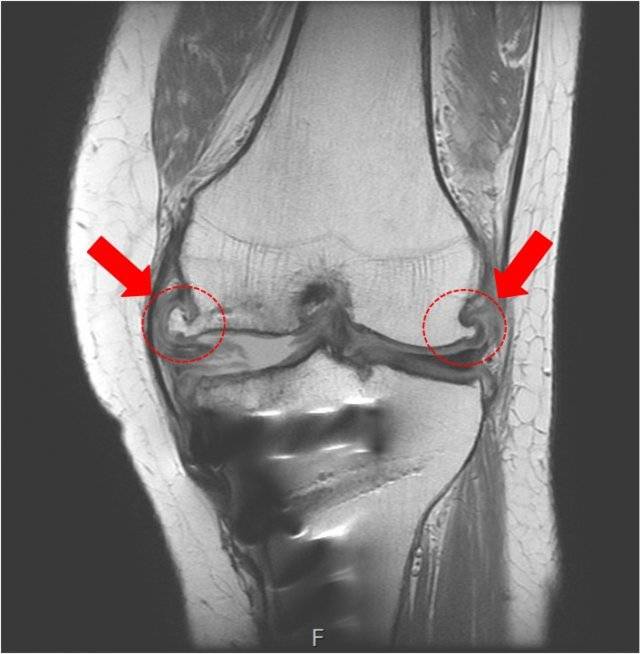 무리한 운동으로 무릎에 나타난 골극(뼈까시). 강남제이에스병원 제공.