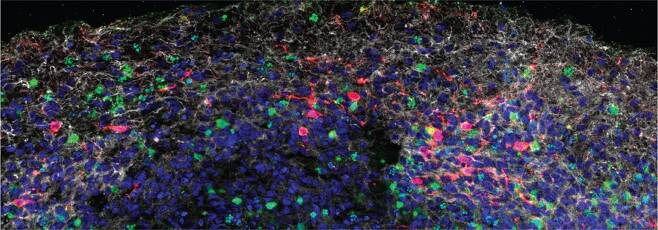 신종 코로나에 노출된 '미니 뇌' 신종 코로나바이러스(적색)에 노출된 뇌 오르가노이드.  감염된 신경세포(회색) 주변의 많은 세포(녹색)가 산소 부족으로 죽어가고 있다.  [예일 의대 이와사키 교수팀의 '실험 의학 저널' 논문 발췌 / 재판매 및 DB 금지]
