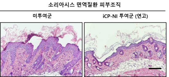 자가면역질환 소리아시스 (건선) 질병모델에서 과도한 염증반응에 의해 비정상적으로 각질층이 붕괴되고 경화되어 불규칙하게 파괴된 피부조직(왼쪽)을 iCP-NI가 정상화시킴(오른쪽).