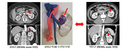 실험군(수술에 3D 프린팅 모델 활용)과 대조군의 수술 전 컴퓨터 단층촬영(CT) 사진 비교.