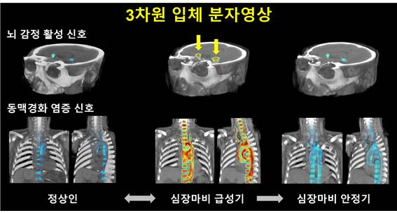 대뇌 감정영역-동맥경화성 염증활성도 삼차원 입체 분자 영상/사진=고려대 구로병원
