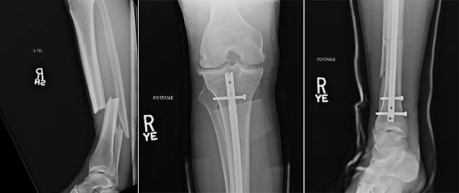▲ 크리스 와이드먼의 수술 전(왼쪽)과 후(가운데, 오른쪽) 사진.