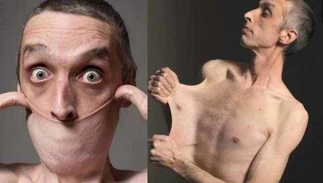 ‘엘러스 단로스 증후군’ 영국 남성. 세계 기네스 협회 공식 인스타그램 캡처