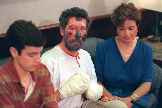 에베레스트에서 손발과 얼굴에 심한 동상을 입고 기적적으로 생환한 벡 웨더스.