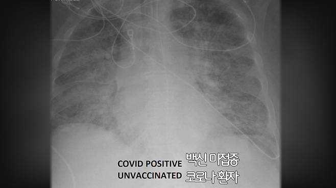 백신을 맞지 않은 상태에서 코로나19에 감염된 환자의 폐 X레이 사진