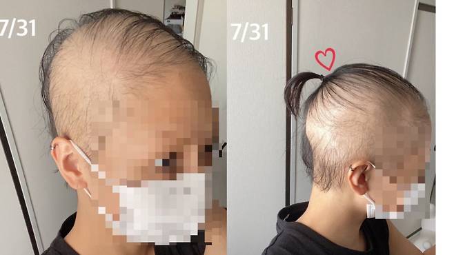 일본의 한 20대 여성이 신종 코로나바이러스 감염증(코로나19) 백신을 접종한 뒤 탈모 증세를 겪었다고 주장하고 나섰다. /사진=A씨 블로그 갈무리