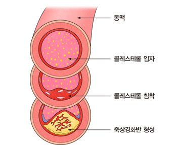 이상지질혈증에 의한 죽상동맥경화 발생 모식도. 자료 서울아산병원