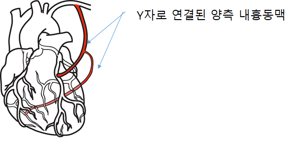 Y자로 연결된 양측 내흉동맥 모식도 /사진 제공=삼성서울병원