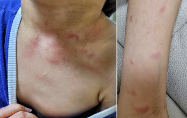 지난 6월부터 어린이집 보육교사에게 폭행을 당한 피해 아동의 목과 팔 부위 상처 / 사진=YTN