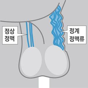 고환에 울퉁불퉁한 혈관이 있다면 정계정맥류가 아닌지 확인해야 한다./사진=조선일보 DB