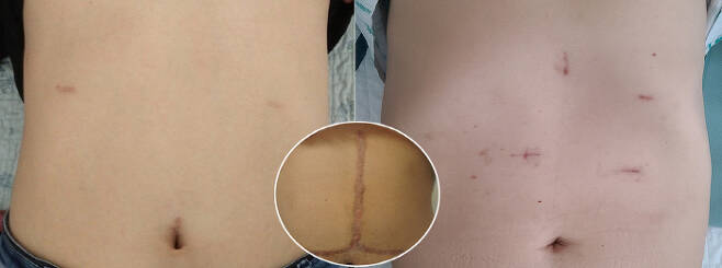복강경으로 간이식 수술을 한 기증자(왼쪽)과 수혜자(오른쪽)의 상처. 원 안은 기존 개복으로 간이식 수술을 한 복부 상처.
