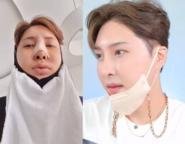 성형수술 직후, 한달 후의 김기수 /사진=유튜브