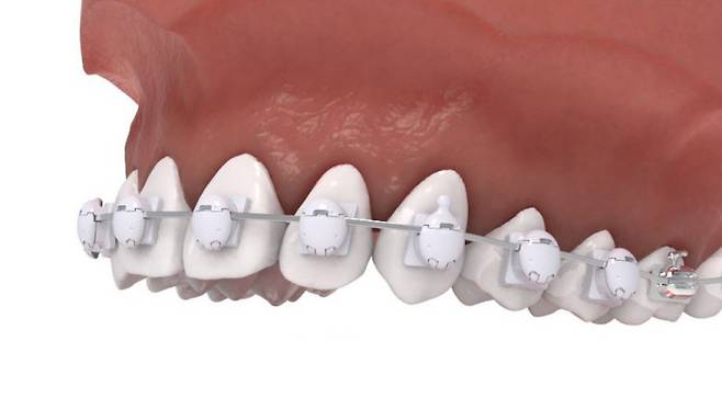 국내 원천기술로 개발되어 특허를 받은 ‘펄레이스’ 치아교정장치 부착 예시. 메디센 제공