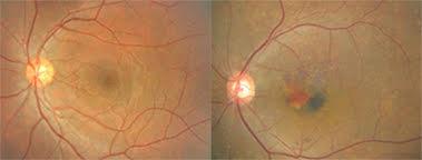 정상인의 눈(왼쪽), 황반변성 환자의 눈. 대한안과학회 제공