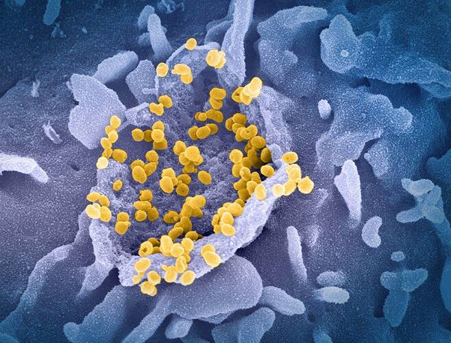 호흡기 세포에 감염된 코로나 바이러스(노란색)의 전자현미경 사진./NIH