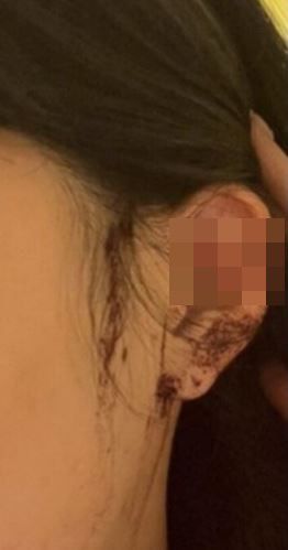 서울의 한 클럽에서 여성손님이 누군가에 의해 귀가 잘렸다며 공개한 사진/소셜미디어