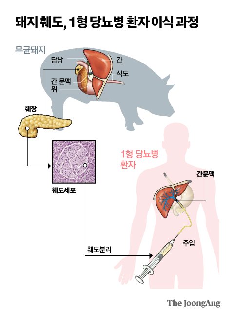 돼지 췌도, 1형 당뇨병 환자 이식 과정. 그래픽=박경민 기자 minn@joongang.co.kr