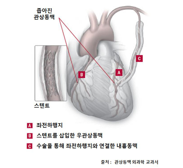 심장 관상동맥과 치료 방법을 보여주는 그림. 은평성모병원 제공
