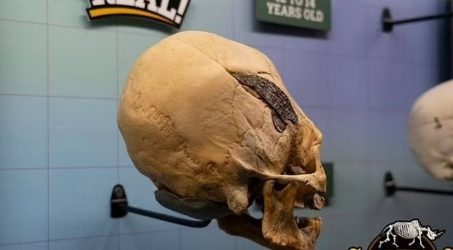 두개골 수술을 받은 것으로 추정되는 2000년 전 인류의 유골