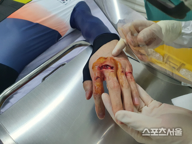 박장혁의 왼손 검지와 중지 윗부분이 심하게 패여 있다. 대한민국선수단