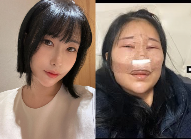 Gag Woman Lee Se-young, who is known to be about to marry soon, has been attracting the attention of netizens by boldly revealing all the molding processes.On the 27th, Lee Se-young uploaded a video of a week of nose surgery with a comment on Isolation and nasal surgery recovery, it was a long recovery period through personal SNS.In the public footage, Lee Se-young delivered the process of recovering nose plastic surgery, especially after the surgery, and after the swelling and recovery, she made up and showed the tapering traces of the surgery without hiding.This is the first day of the two days, and the video is re-examined and attracting the attention of netizens. This is the top ranking of real-time portal sites, and continues to warm up online.He would, too, because Lee Se-young boldly revealed the post-nostalgia image, and his face was more shocked by the unrecognizable swelling of his features.Sacrifice for those interested in nose molding, however much YouTube video (?I am worried that she will be able to disclose without a mosaic process, which is about to be married.Earlier on the 3rd, Lee Se-young posted a video showing Confessions that he will re-operate his nose, which has fallen down through YouTube channel YPTV, which he runs with his Japanese boyfriend Ippei Chan.Ill have nose surgery again in a year after double eyelid surgery.Lee Se-young, who has been steadily hit by a nose filler more than eight times since he was 20 years old, said, I had no nose at all, I did not have a nose, I actually had a nose, he added coolly, adding, I have been in my thirties every year since I was 20 years old.Lee Se-young later revealed the melt of the fumigator with the recent news that he came to melt the nose filler before the nose surge, but the surroundings of the nose were red at that time.Lee Se-young, who emphasized that this video does not encourage plastic surgery, said, I wanted to share all of my YouTuber and share all of my things with you. He said, I will take a photo of the operation and a V log on the day of surgery after surgery.And Lee Se-young, who showed up until the post-molding as promised.In the video, Lee Se-young recalled, I had a nose bone cut, and I applied disinfectant to my face just before I had a nose surgery. I applied disinfectant deeply to my nose.He said, I have a lot of swelling on my chin. My mucous membranes are swollen in my nose, and I keep getting snotty.It is more difficult for nose surgery than twins to recover, because it is difficult for people to breathe and wear masks. Lee Se-young is currently in public relationship with a Japanese boyfriend.Since the two men have gathered topics by revealing their marriage plans next year, it seems that many people have been concerned and interested in Lee Se-youngs bold release of the marriage.]SNS
