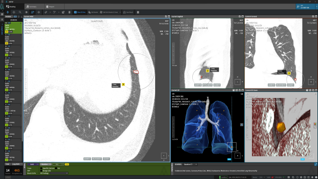 코어라인소프트의 '에이뷰 엘씨에스 플러스’로 흉부를 진단하는 화면. 사진 제공=코어라인소프트