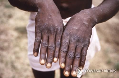 1997년 콩코민주공화국에서 촬영한 원숭이두창 환자의 손 [AP 연합뉴스 자료사진. 질병통제예방센터(CDC) 제공. 재판매 및 DB 금지]