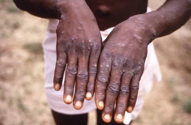 1997년 콩고에서 확인된 원숭이두창 환자의 손이다. 미국 질병통제예방센터(CDC) 제공