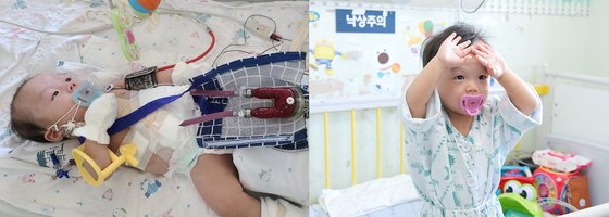 왼쪽부터 체외형 심실보조장치를 삽입한 아기 순후, 퇴원을 앞둔 순후