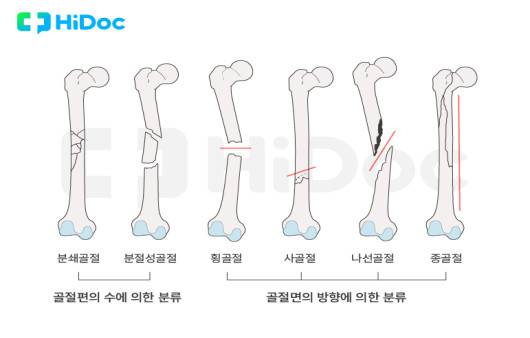 골절의 종류|출처: 하이닥