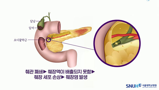 췌장염 주요 원인 중 하나는 '담석'이다. 담석이 췌관을 막으면서 염증이 발생한다. (서울대병원 제공)
