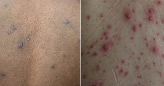 원숭이두창(왼쪽)과 수두 환자의 피부 병변 차이. 사진출처=The Lancet Infectious Disease, 서울대병원