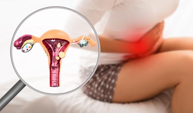 자궁내막증을 수술로 완벽히 제거해도 5년 안에 환자의 40% 정도에서 재발한다. 게티이미지뱅크