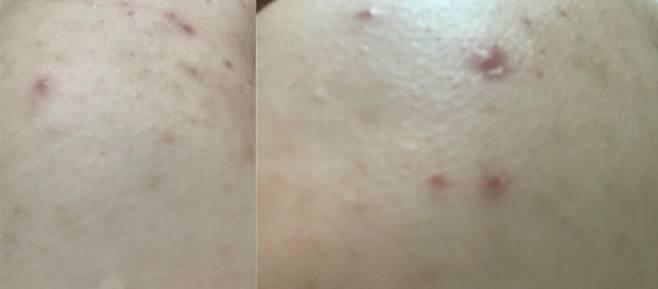 급성 간 중독 피해를 본 강지훈씨(가명.30)가 여전히 온몸에 두드러기로 고생하고 있다. (사진 왼쪽부터 강씨 팔, 어깨) 강씨 제공