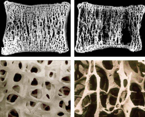 정상인(왼쪽)과 골다공증 환자의 뼈. 대한골대사학회 제공