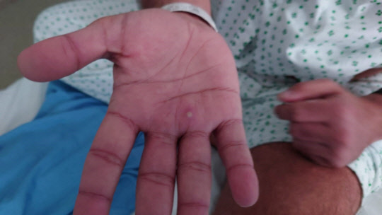 원숭이두창 감염자의 손에 나타난 증상. <로이터=연합뉴스>