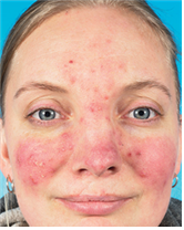 '주사'는 얼굴 전반에 홍반, 모세혈관 확장, 고름 등의 증상을 동반한다.