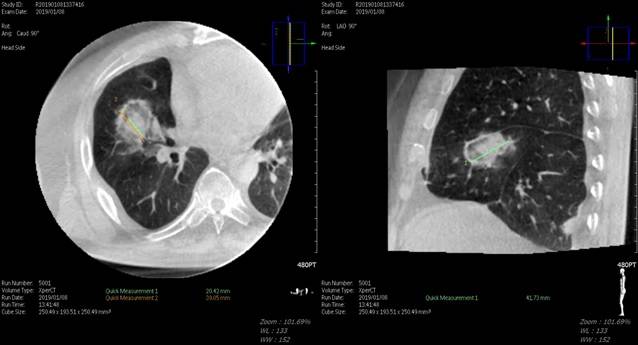 대장암 폐 전이 고주파 열 치료 시술 직후 Cone Beam CT 소견./사진=강북삼성병원 제공