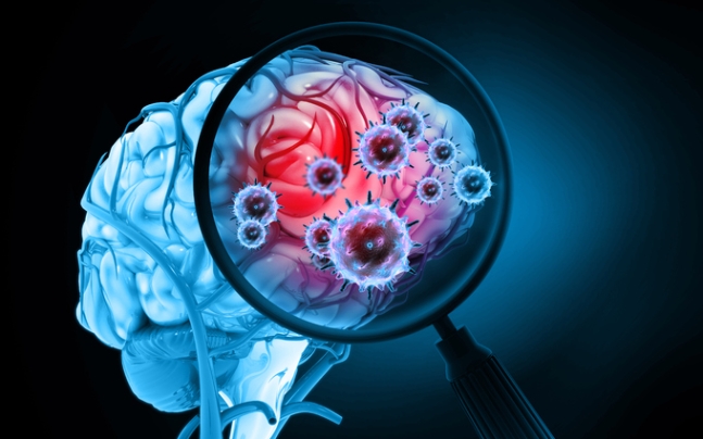 뇌졸중과 뇌종양은 지속적인 두통도 주요 증상이다. [사진=게티이미지]