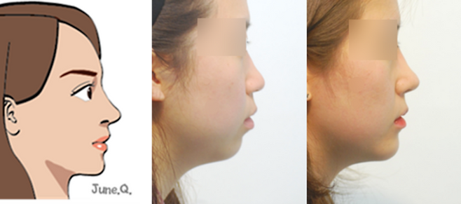 맨 왼쪽은 코와 턱이 조화를 이룬 이미지 그림. 가운데는 한 여성의 옆얼굴. 맨 오른쪽은 코와 턱을 함께 교정한 가운데 여성의 모습.