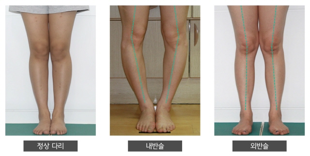 정상인 무릎 모양과 내반슬, 외반슬 무릎의 모양​/사진=뉴본정형외과 제공