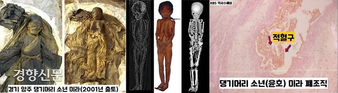 2001년 경기 양주에서 출토된 ‘해평 윤씨 소년(윤호) 미라’. 단정한 댕기머리 차림으로 발굴됐다. 5세 전후의 남아로 판명됐다. 이 소년은 결핵균에 감염되었지만 제대로 된 치료를 받지 못해 사망한 것으로 해석될 수 있다. |단국대 석주선박물관 제공