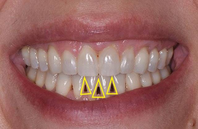 잇몸이 건강한 상태인지 알려면 '블랙 트라이앵글' 유무를 확인해보는 게 좋다./사진=Inside Dentistry